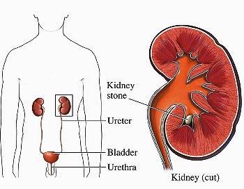 kidney-stones