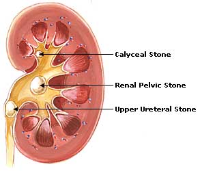 kidney-stones