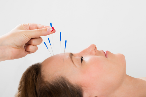 Acupuncture