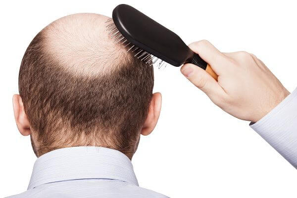 Hair-Loss-Treatment