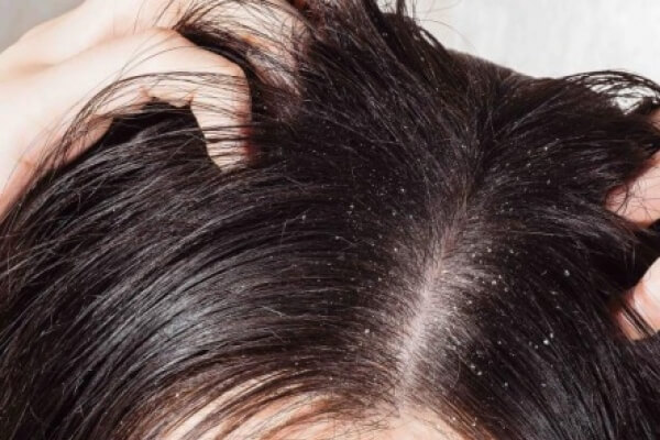 Dandruff Treatment