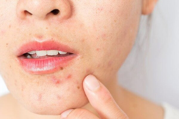 Pimples-and-Black-Spots