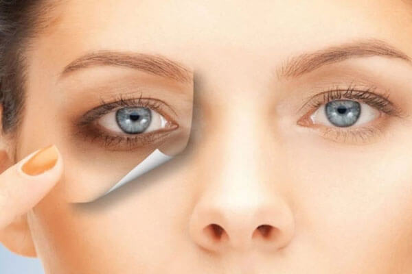 Eye Bag Treatment