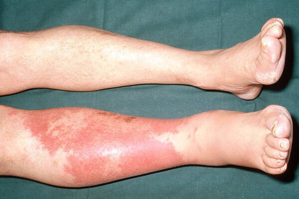 Cellulitis