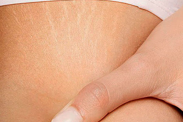 Stretch Marks Treatment