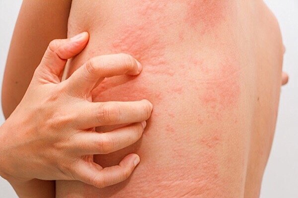 Skin Diseases Treatment